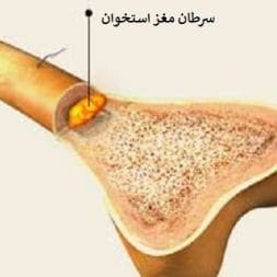 عوامل ایجاد سرطان مغز استخوان-نشانه های سرطان مغز استخوان عوامل ایجاد سرطان مغز استخوان-نشانه های سرطان مغز استخوان