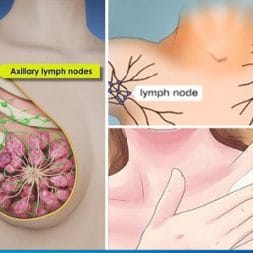 علائم سرطان زیر بغل و توده شیردهی علائم سرطان زیر بغل و توده شیردهی